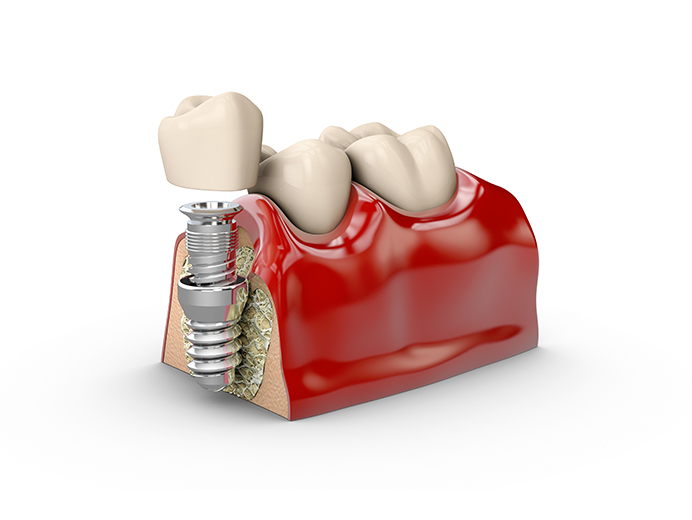 single-tooth-implant